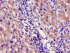 Immunohistochemistry of paraffin-embedded human liver cancer using CYP39A1 Antibody at dilution of 1:100Rabbit anti-Human CYP39A1 Polyclonal Antibody