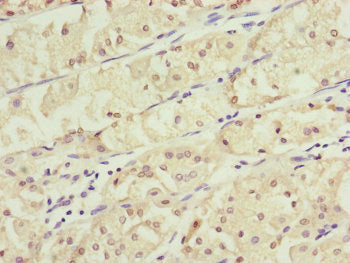 Immunohistochemistry of paraffin-embedded human gastric cancer using KANSL3 Antibody at dilution of 1:100