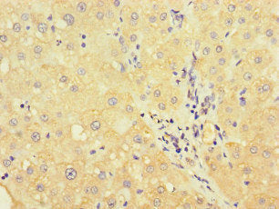 Immunohistochemistry of paraffin-embedded human liver cancer using UVRAG Antibody at dilution of 1:100Rabbit anti-Human UVRAG Polyclonal Antibody