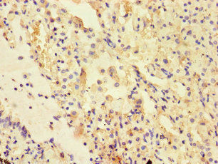 Immunohistochemistry of paraffin-embedded human lung cancer using UVRAG Antibody at dilution of 1:100Rabbit anti-Human UVRAG Polyclonal Antibody