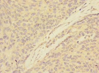 Immunohistochemistry of paraffin-embedded human ovarian cancer using ATXN10 Antibody at dilution of 1:100