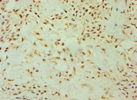 Immunohistochemistry of paraffin-embedded human breast cancer using DKK4 Antibody at dilution of 1:100Rabbit anti-Human DKK4 Polyclonal Antibody