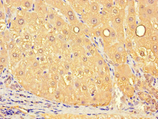Immunohistochemistry of paraffin-embedded human liver tissue using SLC25A10 Antibody at dilution of 1:100Rabbit anti-Human SLC25A10 Polyclonal Antibody