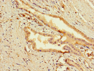 Immunohistochemistry of paraffin-embedded human prostata cancer using SLC25A10 Antibody at dilution of 1:100Rabbit anti-Human SLC25A10 Polyclonal Antibody