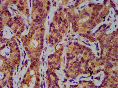IHC image of AASS Antibody diluted at 1:400 and staining in paraffin-embedded human liver cancer performed on a Leica BondTM system. After dewaxing and hydration, antigen retrieval was mediated by high pressure in a citrate buffer (pH 6.0). Section was blocked with 10% normal goat serum 30min at RT. Then primary antibody (1% BSA) was incubated at 4°C overnight. The primary is detected by a biotinylated secondary antibody and visualized using an HRP conjugated SP system.