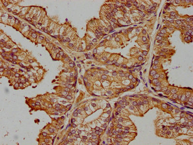 IHC image of ZRANB1 Antibody diluted at 1:400 and staining in paraffin-embedded human prostate cancer performed on a Leica BondTM system. After dewaxing and hydration, antigen retrieval was mediated by high pressure in a citrate buffer (pH 6.0). Section was blocked with 10% normal goat serum 30min at RT. Then primary antibody (1% BSA) was incubated at 4°C overnight. The primary is detected by a biotinylated secondary antibody and visualized using an HRP conjugated SP system.Rabbit anti-Human ZRANB1 Polyclonal Antibody
