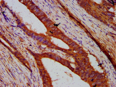 IHC image of SUN2 Antibody diluted at 1:200 and staining in paraffin-embedded human colon cancer performed on a Leica BondTM system. After dewaxing and hydration, antigen retrieval was mediated by high pressure in a citrate buffer (pH 6.0). Section was blocked with 10% normal goat serum 30min at RT. Then primary antibody (1% BSA) was incubated at 4°C overnight. The primary is detected by a biotinylated secondary antibody and visualized using an HRP conjugated SP system.Rabbit anti-Human SUN2 Polyclonal Antibody