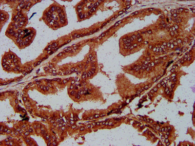 IHC image of SUN2 Antibody diluted at 1:200 and staining in paraffin-embedded human prostate tissue performed on a Leica BondTM system. After dewaxing and hydration, antigen retrieval was mediated by high pressure in a citrate buffer (pH 6.0). Section was blocked with 10% normal goat serum 30min at RT. Then primary antibody (1% BSA) was incubated at 4°C overnight. The primary is detected by a biotinylated secondary antibody and visualized using an HRP conjugated SP system.Rabbit anti-Human SUN2 Polyclonal Antibody