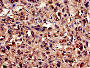Immunocytochemistry analysis of human melanoma using UBQLN2 Antibody at dilution of 1:100Rabbit anti-Human UBQLN2 Polyclonal Antibody