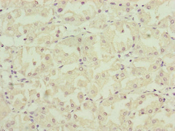 Immunohistochemistry of paraffin-embedded human gastric cancer using NDUFA12 Antibody at dilution of 1:100Rabbit anti-Human NDUFA12 Polyclonal Antibody