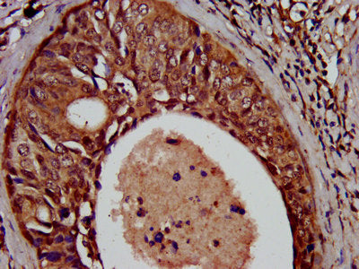 IHC image of the antibody diluted at 1:500 and staining in paraffin-embedded human cervical cancer performed on a Leica BondTM system. After dewaxing and hydration, antigen retrieval was mediated by high pressure in a citrate buffer (pH 6.0). Section was blocked with 10% normal goat serum 30min at RT. Then primary antibody (1% BSA) was incubated at 4°C overnight. The primary is detected by a biotinylated secondary antibody and visualized using an HRP conjugated SP system.Rabbit anti-Human SCN11A Polyclonal Antibody