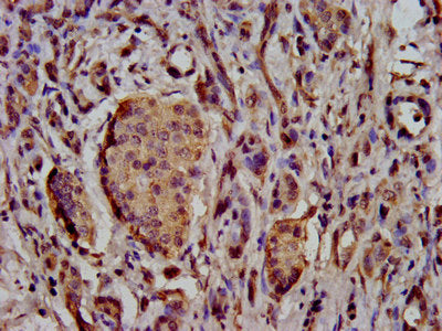 IHC image of SCN11A Antibody diluted at 1:500 and staining in paraffin-embedded human pancreatic cancer performed on a Leica BondTM system. After dewaxing and hydration, antigen retrieval was mediated by high pressure in a citrate buffer (pH 6.0). Section was blocked with 10% normal goat serum 30min at RT. Then primary antibody (1% BSA) was incubated at 4°C overnight. The primary is detected by a biotinylated secondary antibody and visualized using an HRP conjugated SP system.Rabbit anti-Human SCN11A Polyclonal Antibody