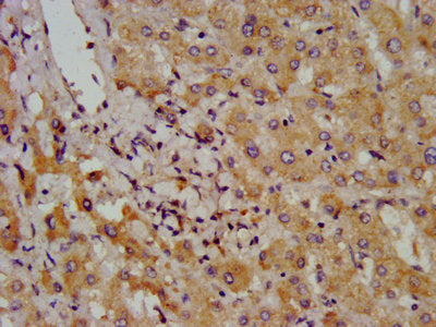 IHC image of the antibody diluted at 1:800 and staining in paraffin-embedded human liver cancer performed on a Leica BondTM system. After dewaxing and hydration, antigen retrieval was mediated by high pressure in a citrate buffer (pH 6.0). Section was blocked with 10% normal goat serum 30min at RT. Then primary antibody (1% BSA) was incubated at 4°C overnight. The primary is detected by a biotinylated secondary antibody and visualized using an HRP conjugated SP system.