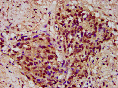 IHC image of the antibody diluted at 1:300 and staining in paraffin-embedded human ovarian cancer performed on a Leica BondTM system. After dewaxing and hydration, antigen retrieval was mediated by high pressure in a citrate buffer (pH 6.0). Section was blocked with 10% normal goat serum 30min at RT. Then primary antibody (1% BSA) was incubated at 4°C overnight. The primary is detected by a biotinylated secondary antibody and visualized using an HRP conjugated SP system.Rabbit anti-Human PYGO2 Polyclonal Antibody
