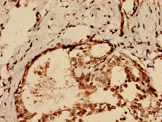 Immunohistochemistry analysis of human breast cancer using CHID1 Antibody at dilution of 1:100Rabbit anti-Human CHID1 Polyclonal Antibody