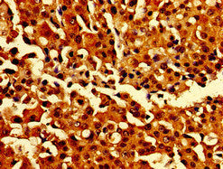 Immunohistochemistry of paraffin-embedded human breast cancer using the antibody at dilution of 1:100