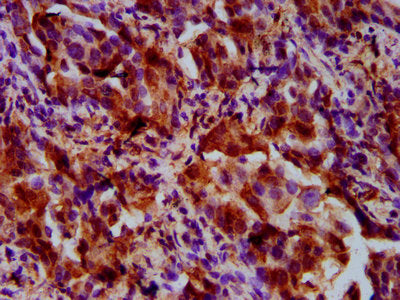 IHC image of the antibody diluted at 1:500 and staining in paraffin-embedded human lung cancer performed on a Leica BondTM system. After dewaxing and hydration, antigen retrieval was mediated by high pressure in a citrate buffer (pH 6.0). Section was blocked with 10% normal goat serum 30min at RT. Then primary antibody (1% BSA) was incubated at 4°C overnight. The primary is detected by a biotinylated secondary antibody and visualized using an HRP conjugated SP system.Rabbit anti-Human UPF3B Polyclonal Antibody