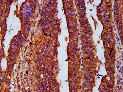 IHC image of UPF3B Antibody diluted at 1:500 and staining in paraffin-embedded human colon cancer performed on a Leica BondTM system. After dewaxing and hydration, antigen retrieval was mediated by high pressure in a citrate buffer (pH 6.0). Section was blocked with 10% normal goat serum 30min at RT. Then primary antibody (1% BSA) was incubated at 4°C overnight. The primary is detected by a biotinylated secondary antibody and visualized using an HRP conjugated SP system.Rabbit anti-Human UPF3B Polyclonal Antibody