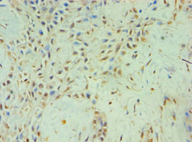Immunohistochemistry of paraffin-embedded human breast cancer using TBL1XR1 Antibody at dilution of 1:100Rabbit anti-Human TBL1XR1 Polyclonal Antibody