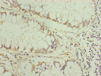 Immunohistochemistry of paraffin-embedded human colon cancer using TRIM31 Antibody at dilution of 1:100Rabbit anti-Human TRIM31 Polyclonal Antibody