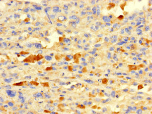 Immunohistochemistry of paraffin-embedded human melanoma using IFI27L2 Antibody at dilution of 1:100Rabbit anti-Human IFI27L2 Polyclonal Antibody