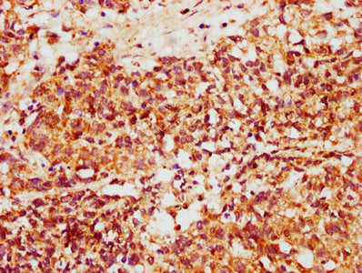 IHC image of the antibody diluted at 1:500 and staining in paraffin-embedded human ovarian cancer performed on a Leica BondTM system. After dewaxing and hydration, antigen retrieval was mediated by high pressure in a citrate buffer (pH 6.0). Section was blocked with 10% normal goat serum 30min at RT. Then primary antibody (1% BSA) was incubated at 4°C overnight. The primary is detected by a biotinylated secondary antibody and visualized using an HRP conjugated SP system.