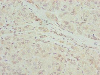 Immunohistochemistry of paraffin-embedded human liver cancer using RIBC2 Antibody at dilution of 1:100Rabbit anti-Human RIBC2 Polyclonal Antibody