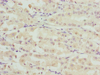 Immunohistochemistry of paraffin-embedded human gastric cancer using RIBC2 Antibody at dilution of 1:100Rabbit anti-Human RIBC2 Polyclonal Antibody