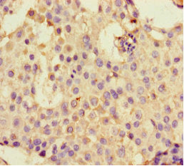 Immunohistochemistry of paraffin-embedded human breast cancer using DHX33 Antibody at dilution of 1:100Rabbit anti-Human DHX33 Polyclonal Antibody