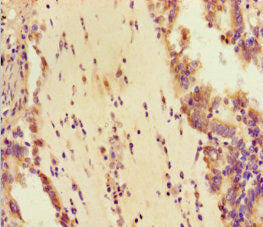 Immunohistochemistry of paraffin-embedded human lung cancer using DHX33 Antibody at dilution of 1:100Rabbit anti-Human DHX33 Polyclonal Antibody