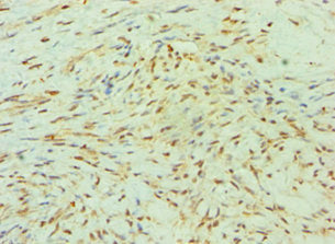 Immunohistochemistry of paraffin-embedded human breast cancer using SMYD3 Antibody at dilution of 1:100Rabbit anti-Human SMYD3 Polyclonal Antibody