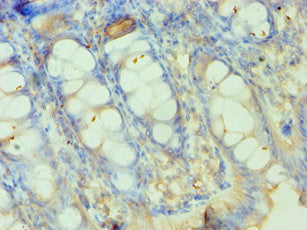 Immunohistochemistry of paraffin-embedded human colon tissue using SMYD3 Antibody at dilution of 1:100Rabbit anti-Human SMYD3 Polyclonal Antibody
