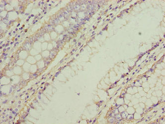 Immunohistochemistry of paraffin-embedded human colon cancer using NMUR1 Antibody at dilution of 1:100Rabbit anti-Human NMUR1 Polyclonal Antibody