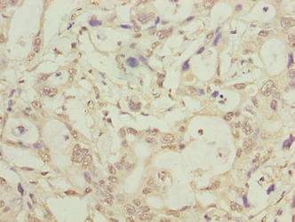 Immunohistochemistry of paraffin-embedded human pancreatic cancer using LRTM1 Antibody at dilution of 1:100