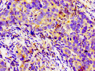 Immunohistochemistry of paraffin-embedded human pancreatic cancer using LGR6 Antibody at dilution of 1:100
