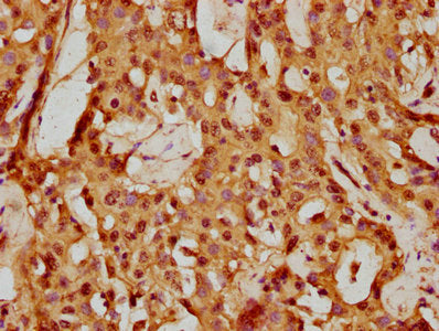IHC image of BCL2L10 Antibody diluted at 1:150 and staining in paraffin-embedded human liver cancer performed on a Leica BondTM system. After dewaxing and hydration, antigen retrieval was mediated by high pressure in a citrate buffer (pH 6.0). Section was blocked with 10% normal goat serum 30min at RT. Then primary antibody (1% BSA) was incubated at 4°C overnight. The primary is detected by a biotinylated secondary antibody and visualized using an HRP conjugated SP system.