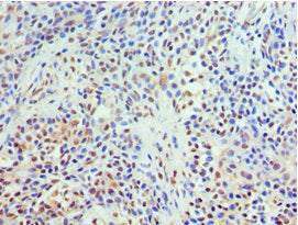 Immunohistochemistry of paraffin-embedded human breast cancer using TXNRD2 Antibody at dilution of 1:100Rabbit anti-Human TXNRD2 Polyclonal Antibody