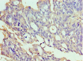 Immunohistochemistry of paraffin-embedded human endometrial cancer using TXNRD2 Antibody at dilution of 1:100Rabbit anti-Human TXNRD2 Polyclonal Antibody