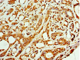 Immunohistochemistry of paraffin-embedded human breast cancer using ARFGAP3 Antibody at dilution of 1:100Rabbit anti-Human ARFGAP3 Polyclonal Antibody