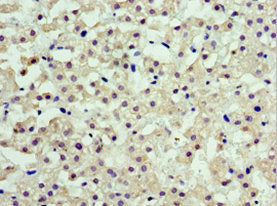 Immunohistochemistry of paraffin-embedded human liver cancer using ARFGAP3 Antibody at dilution of 1:100Rabbit anti-Human ARFGAP3 Polyclonal Antibody