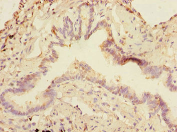 Immunohistochemistry of paraffin-embedded human lung tissue using DCP1A Antibody at dilution of 1:100Rabbit anti-Human DCP1A Polyclonal Antibody