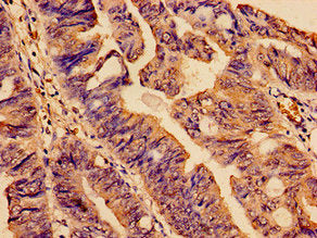 Immunohistochemistry analysis of human colon cancer using the antibody at dilution of 1:100Rabbit anti-Human SMC4 Polyclonal Antibody