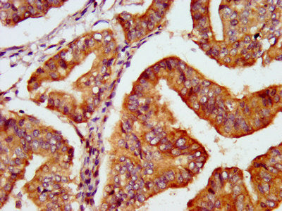 IHC image of PNPO Antibody diluted at 1:600 and staining in paraffin-embedded human endometrial cancer performed on a Leica BondTM system. After dewaxing and hydration, antigen retrieval was mediated by high pressure in a citrate buffer (pH 6.0). Section was blocked with 10% normal goat serum 30min at RT. Then primary antibody (1% BSA) was incubated at 4°C overnight. The primary is detected by a biotinylated secondary antibody and visualized using an HRP conjugated SP system.Rabbit anti-Human PNPO Polyclonal Antibody
