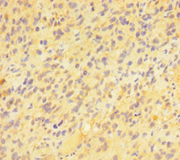 Immunohistochemistry of paraffin-embedded human glioma using the antibody at dilution of 1:100Rabbit anti-Human PAG1 Polyclonal Antibody