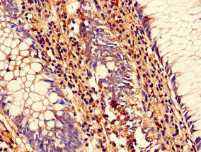 Immunohistochemistry of paraffin-embedded human colon cancer using SENP1 Antibody at dilution of 1:100Rabbit anti-Human SENP1 Polyclonal Antibody