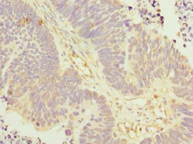 Immunohistochemistry of paraffin-embedded human ovarian cancer using KLHL42 Antibody at dilution of 1:100