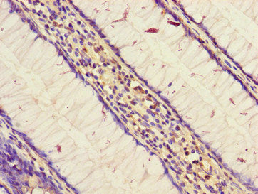 Immunohistochemistry of paraffin-embedded human colon cancer using the antibody at dilution of 1: 100Rabbit anti-Human STARD9 Polyclonal Antibody
