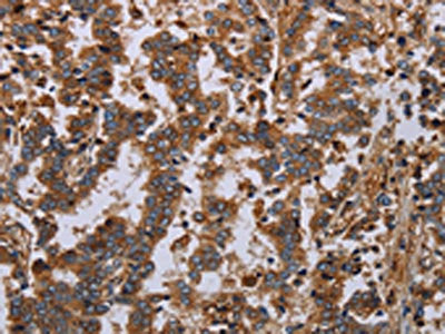 The image on the left is immunohistochemistry of paraffin-embedded Human liver cancer tissue using GDF2 Antibody(GDF2 Antibody) at dilution 1/40, on the right is treated with synthetic peptide. (Original magnification: ×200)Rabbit anti-Human GDF2 Polyclonal Antibody