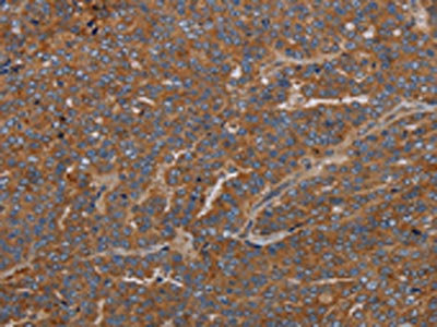 The image on the left is immunohistochemistry of paraffin-embedded Human ovarian cancer tissue using the antibody Antibody) at dilution 1/40, on the right is treated with synthetic peptide. (Original magnification: ×200)Rabbit anti-Human GDF2 Polyclonal Antibody