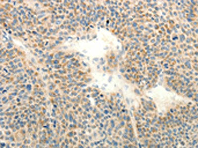 The image on the left is immunohistochemistry of paraffin-embedded Human liver cancer tissue using RXFP3 Antibody(RXFP3 Antibody) at dilution 1/20, on the right is treated with synthetic peptide. (Original magnification: ×200)Rabbit anti-Human RXFP3 Polyclonal Antibody